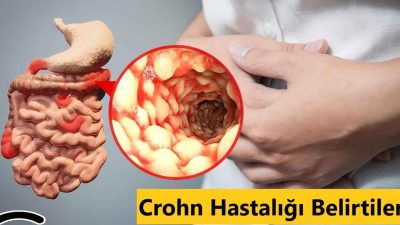 Sindirim sistemini ağızdan anüse kadar etkileyebilen Crohn hastalığı, kronik ve